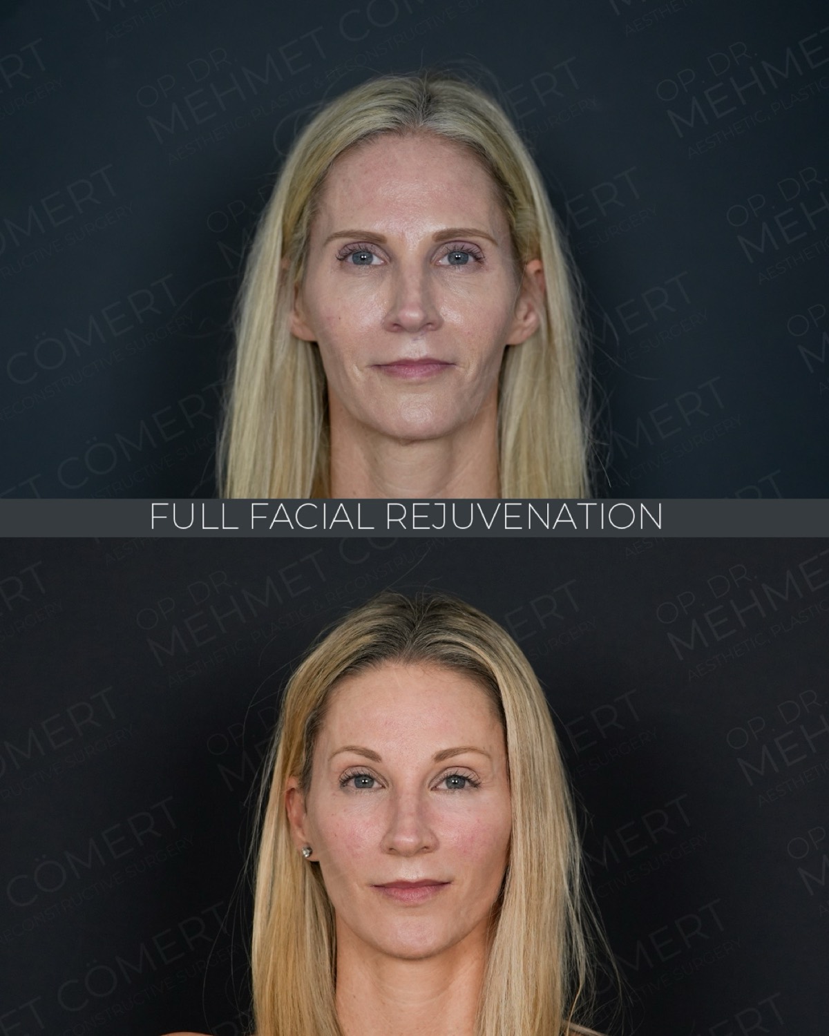 Facial Rejuvenation — before and after