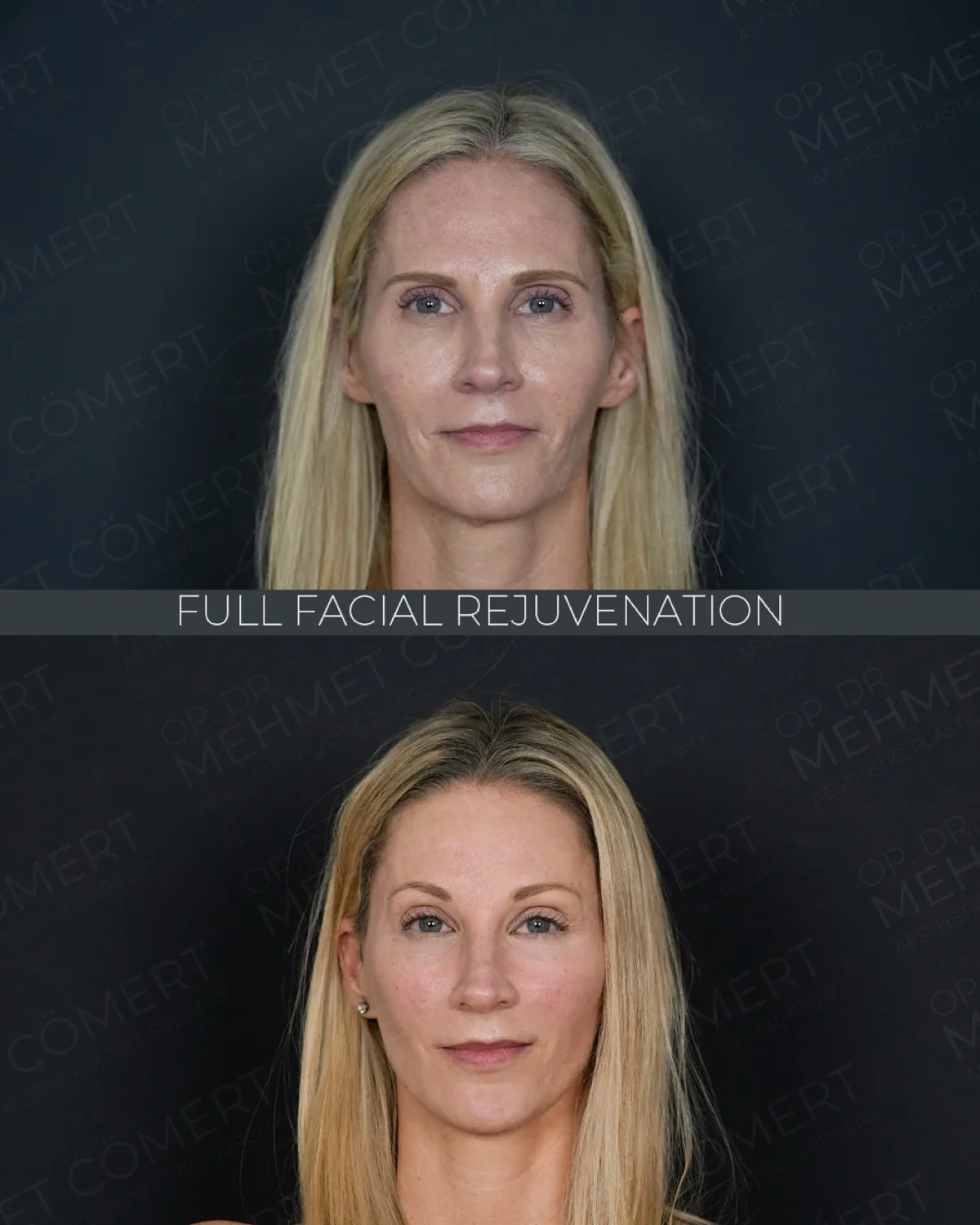Deep plane facelift in Istanbul, before and after, woman age 41 from the United States