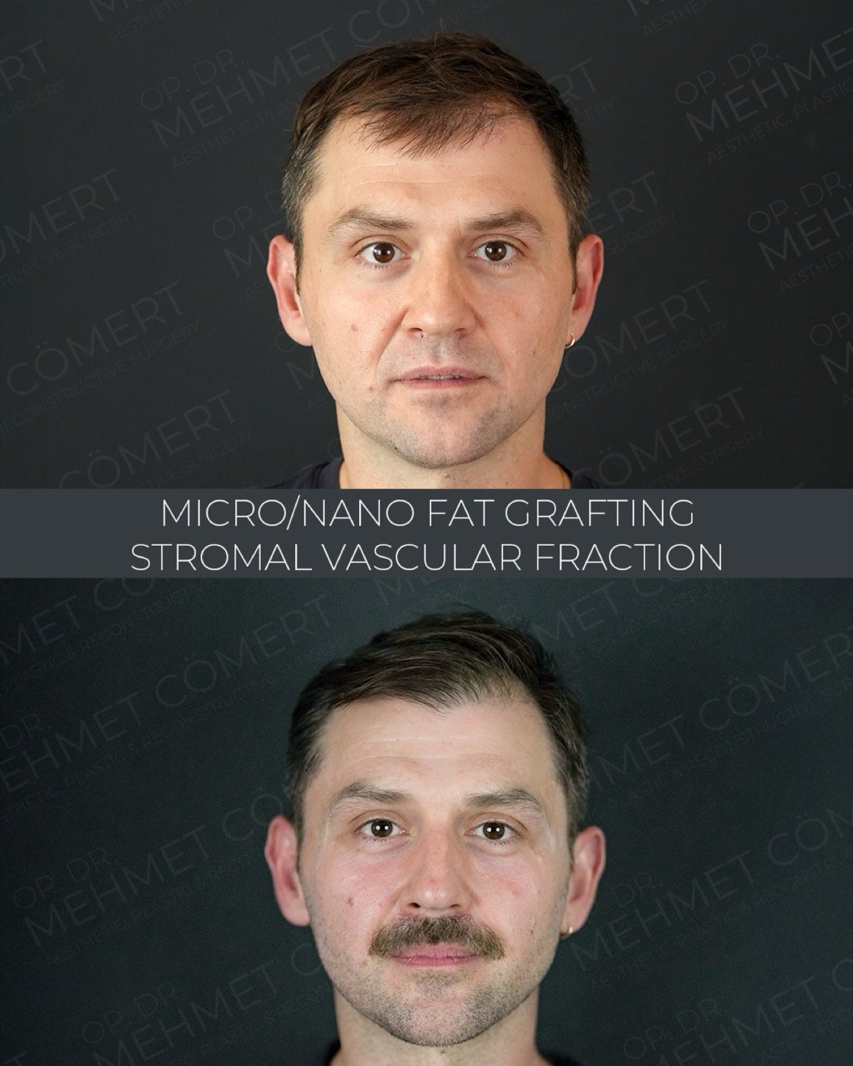 Fat, Nano-Fat & Micro-Fat Grafting — before and after