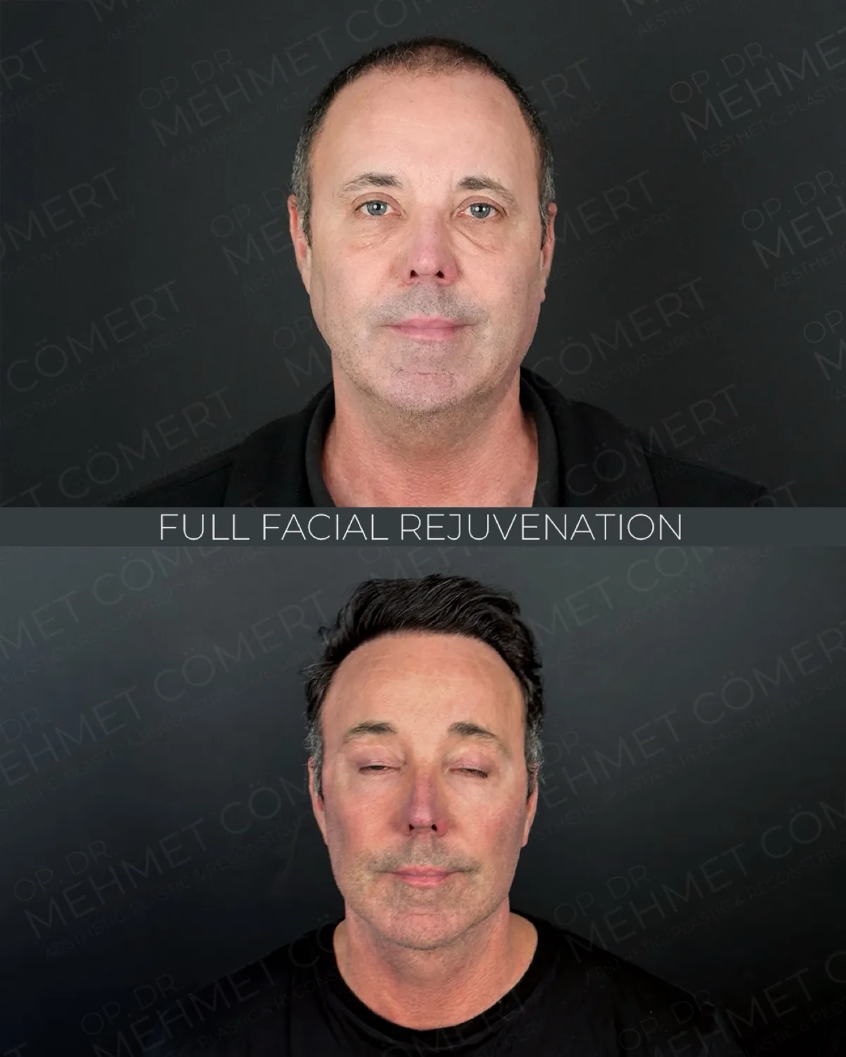 Deep plane facelift before and after, woman age 58 from the United Kingdom