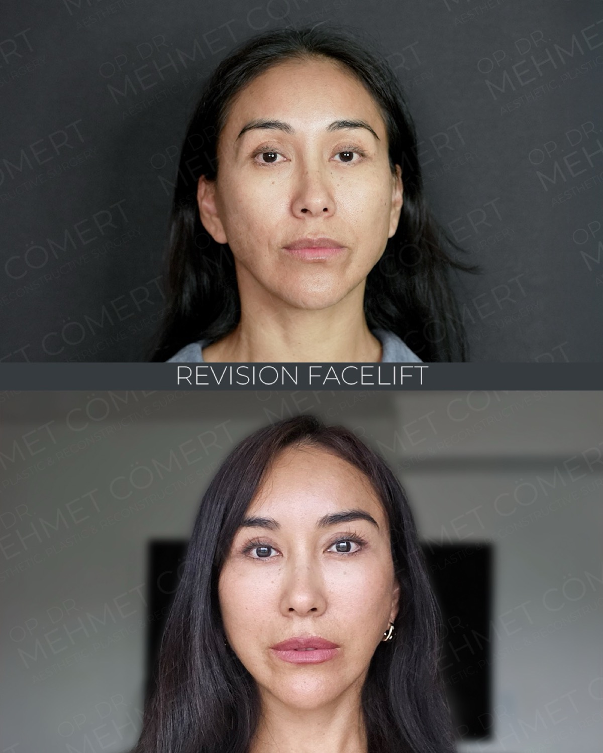 Revision Deep Plane Facelift — before and after