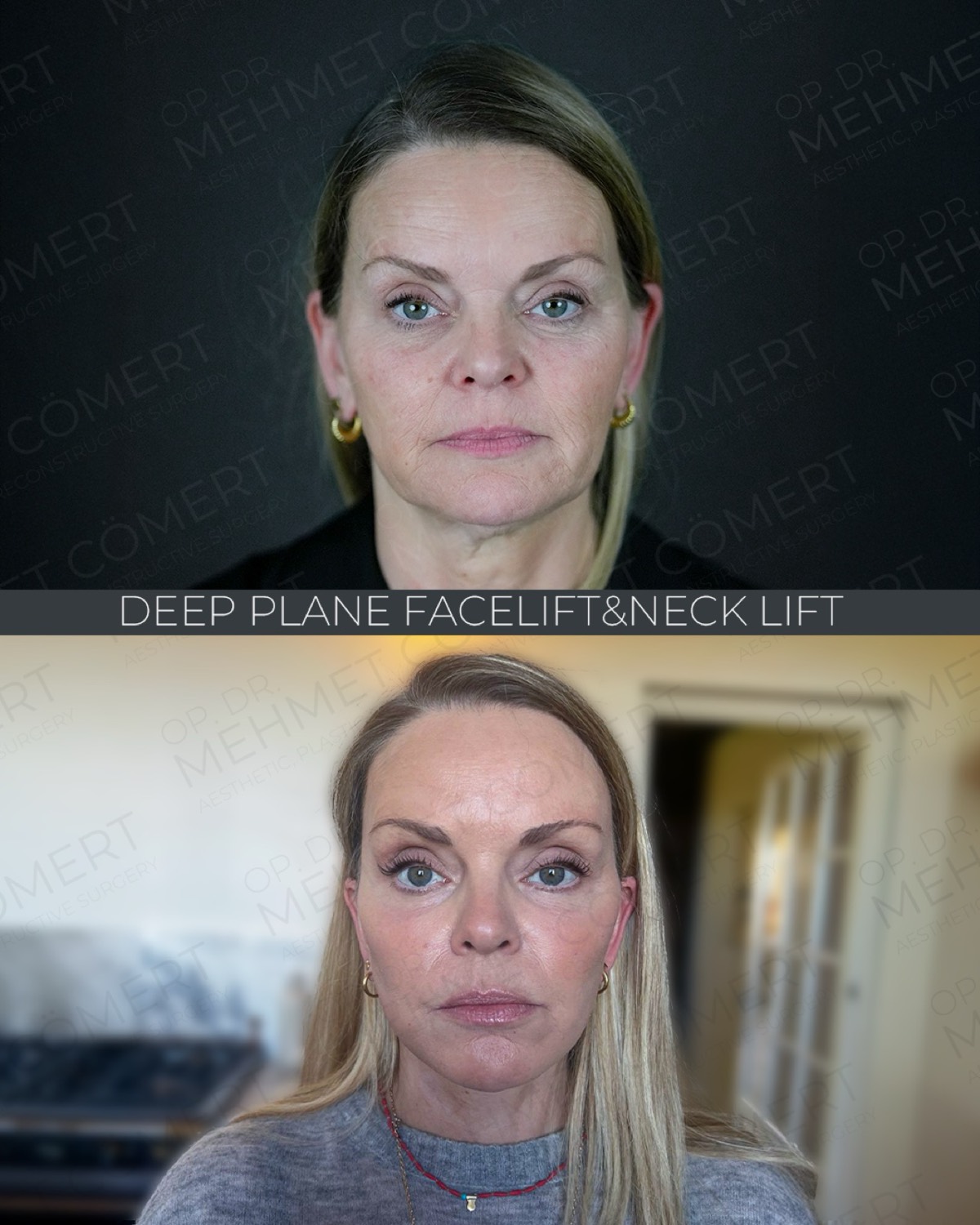 Deep Plane Facelift — before and after