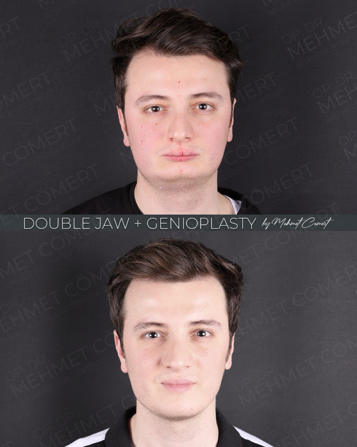Double Jaw — before and after