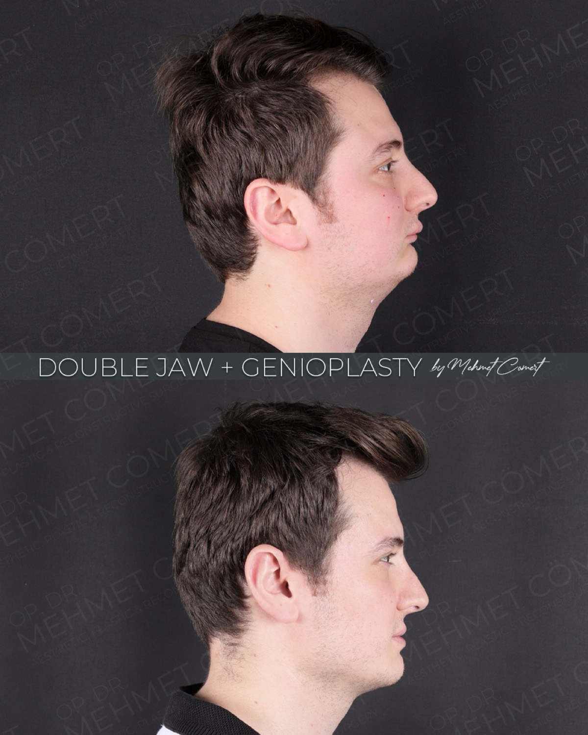 Opposite-side profile before and after double jaw surgery with genioplasty showing chin projection and jawline definition in a 28-year-old patient at 1 month post-op