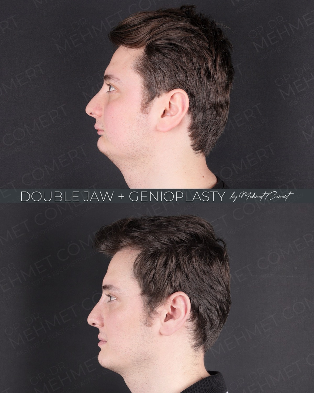 Orthognathic Surgery — double jaw before and after