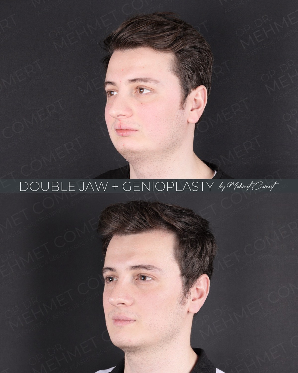 Three-quarter view before and after double jaw surgery with genioplasty in a 28-year-old patient at 1 month post-op