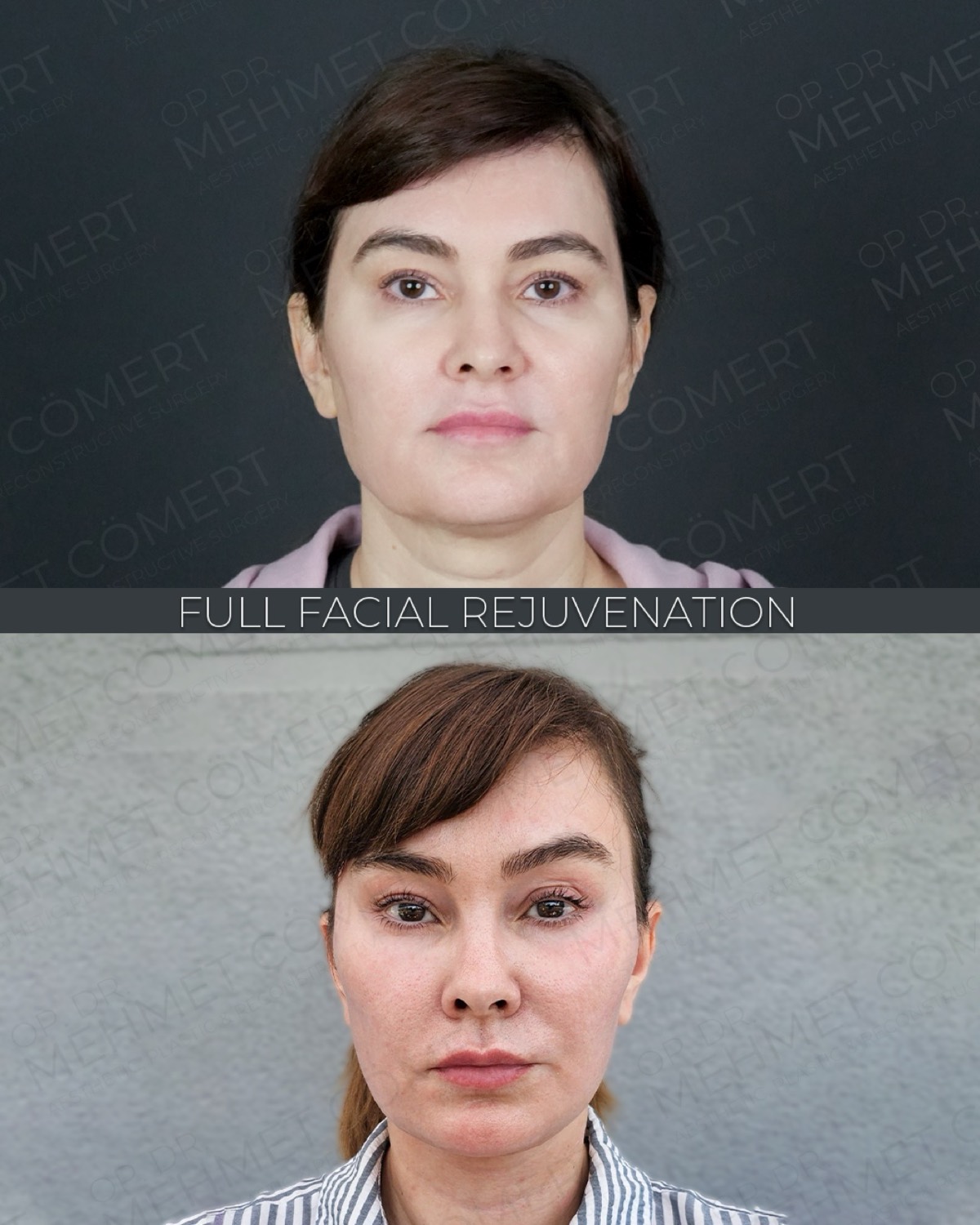 Deep Plane Facelift — before and after