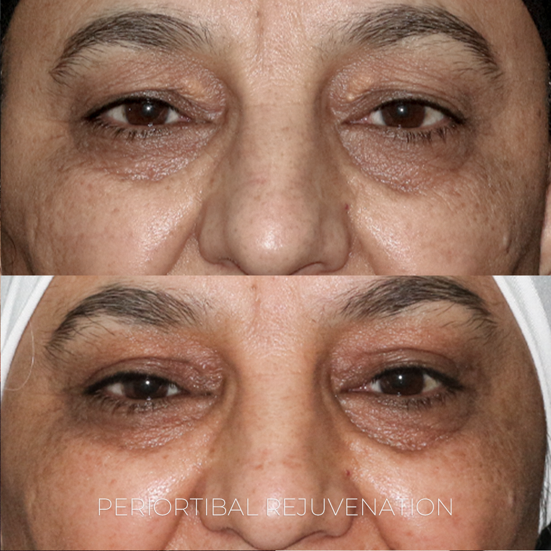 Periorbital Rejuvenation