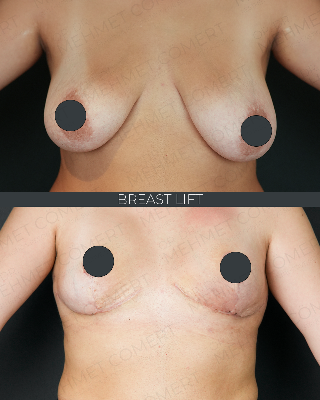 Breast Lift