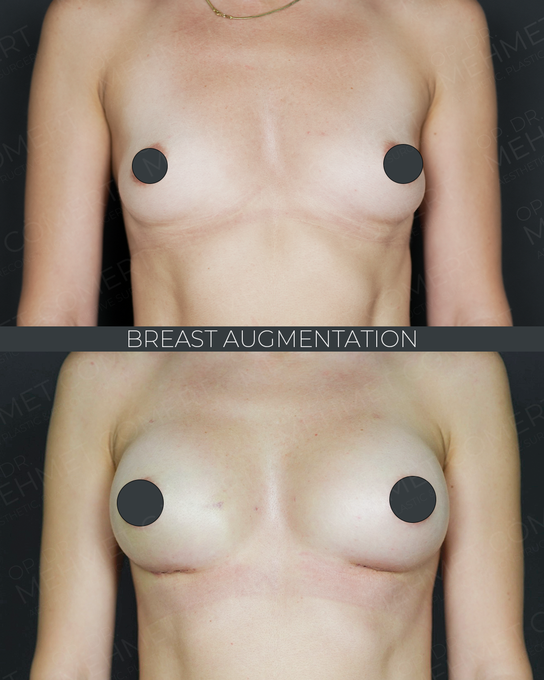 Breast Augmentation