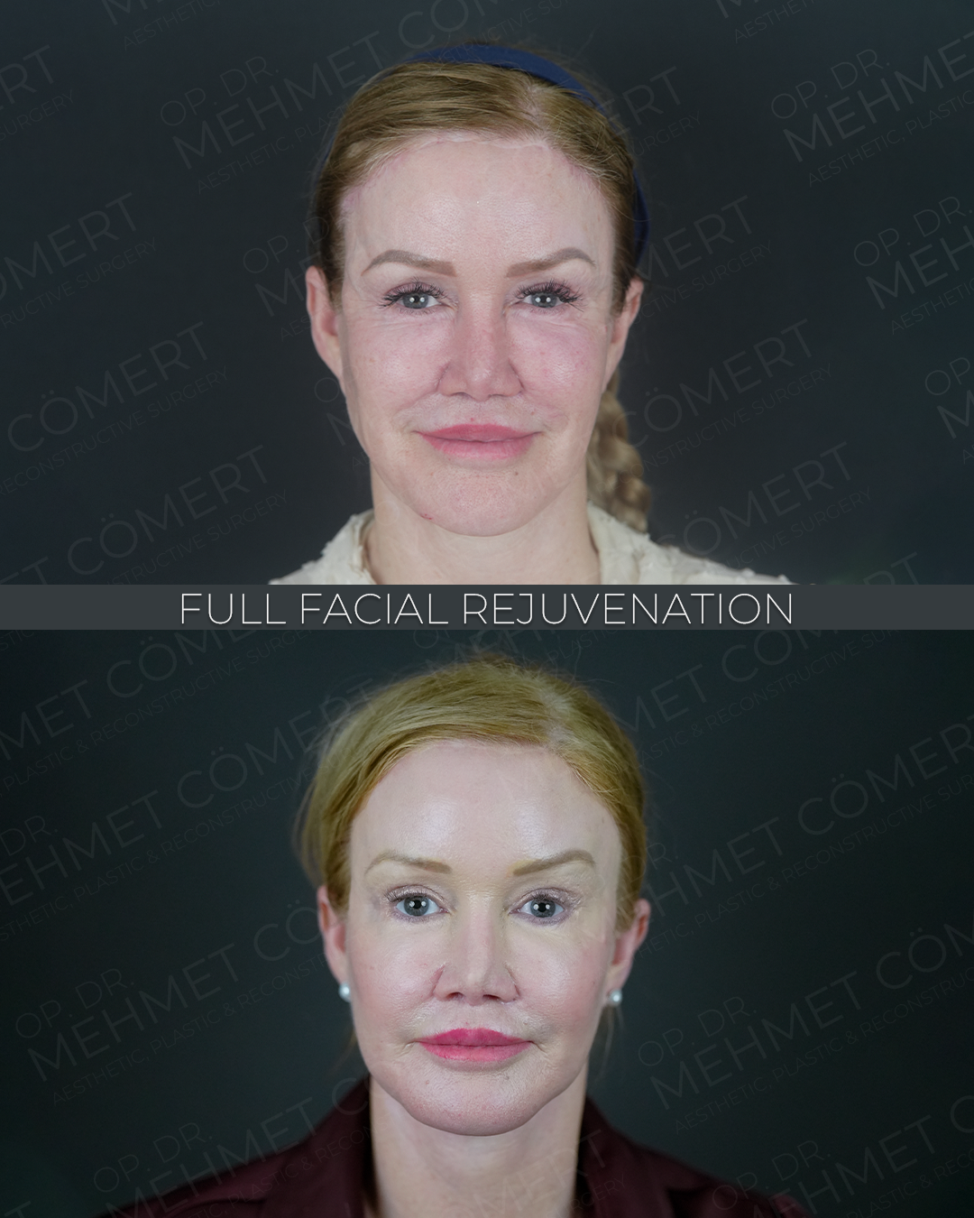Full Facial Rejuvenation