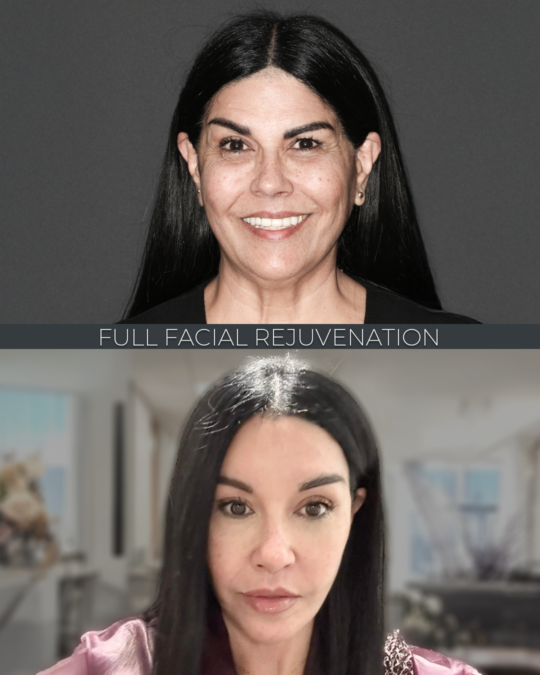 Full Facial Rejuvenation