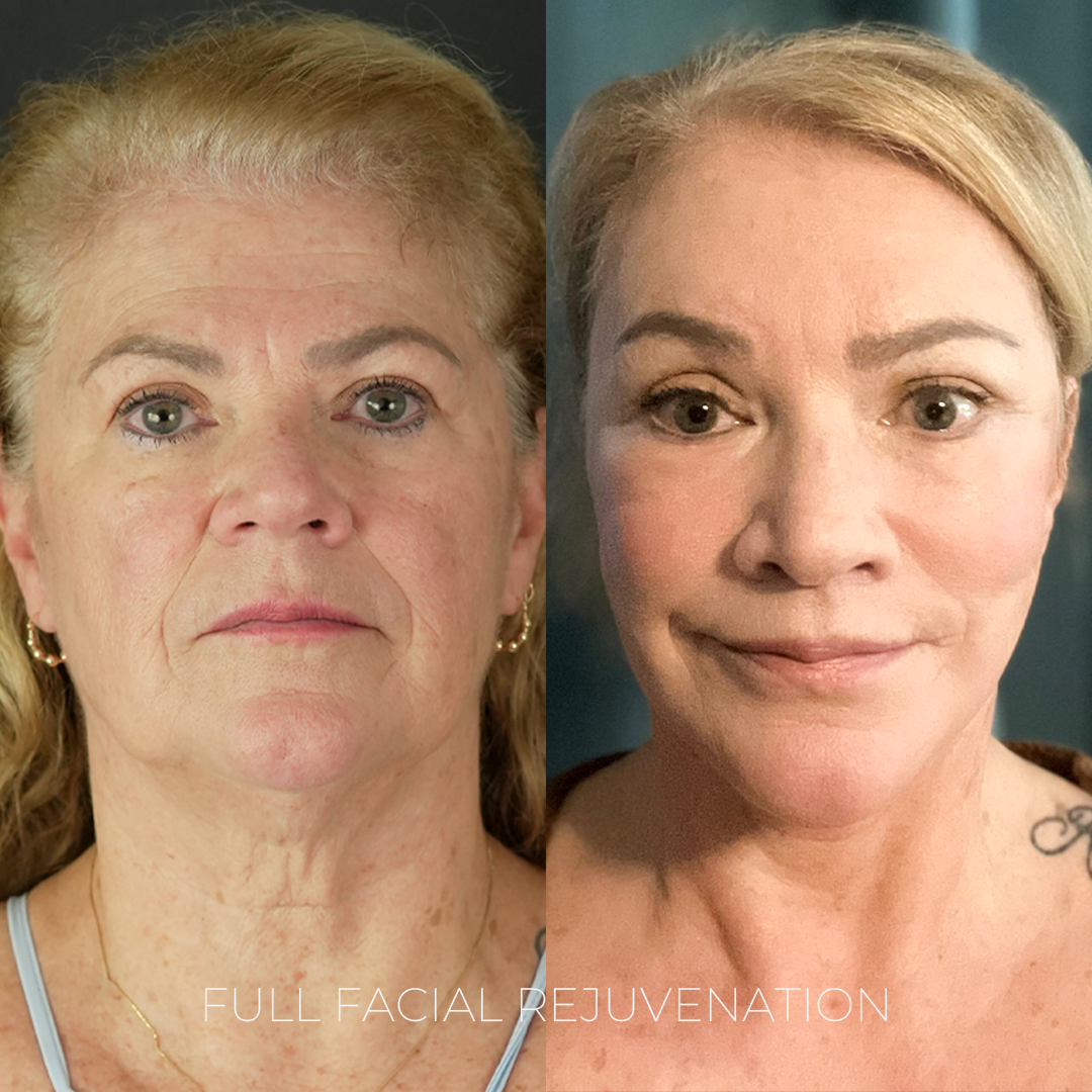 Full Facial Rejuvenation