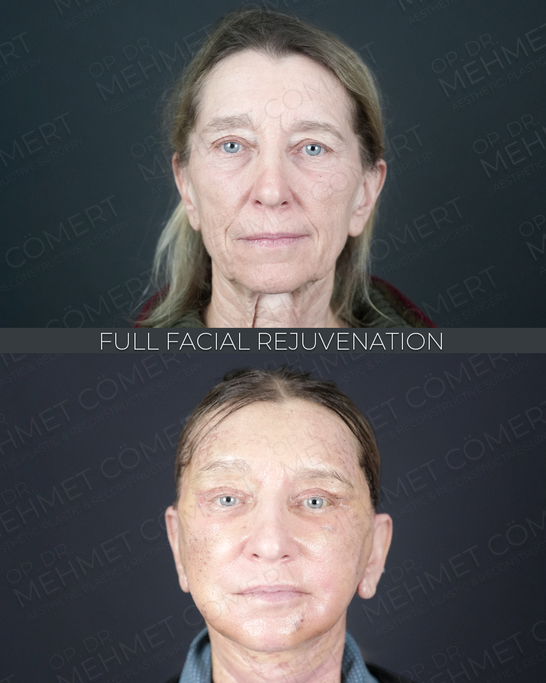 Full Facial Rejuvenation