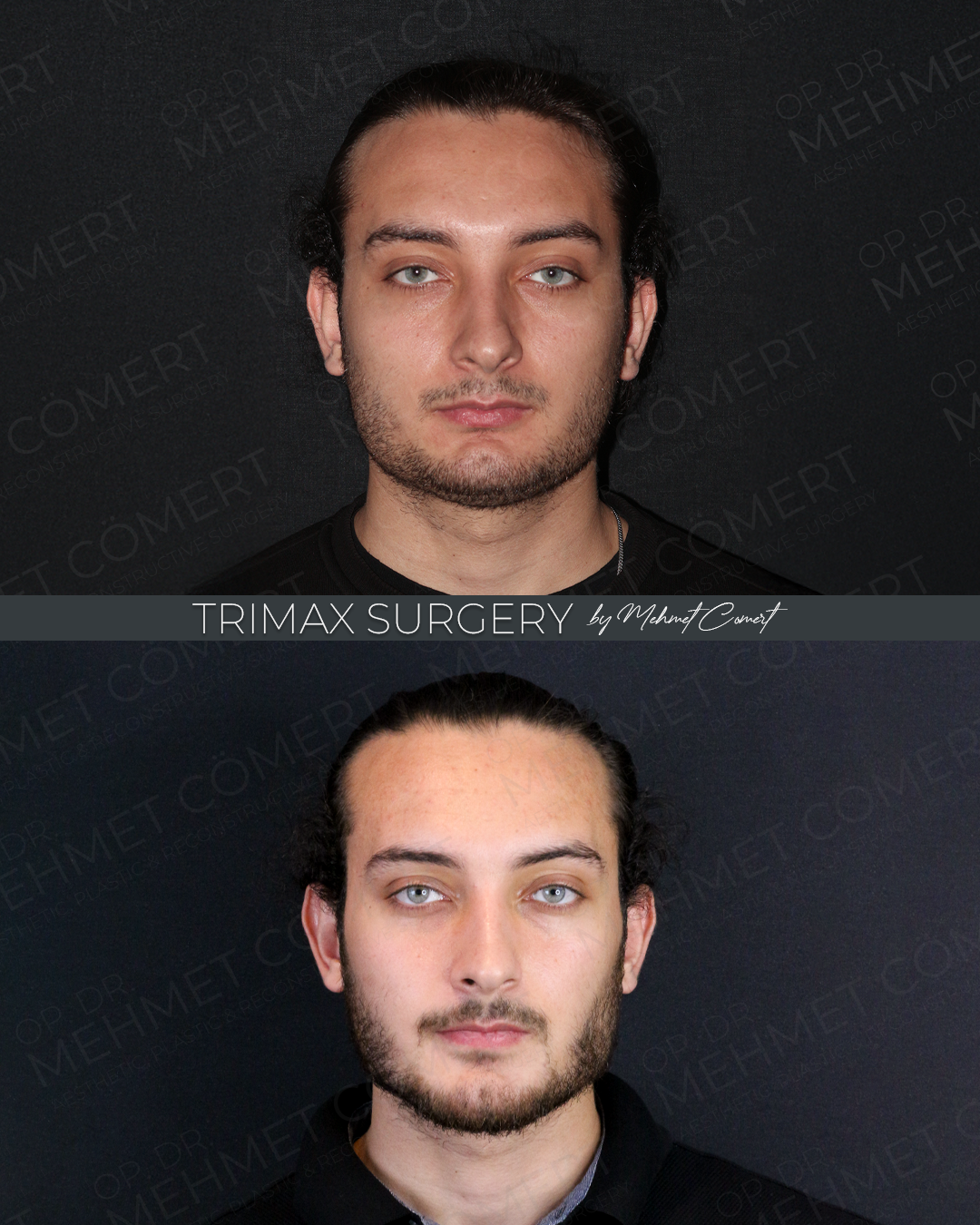 Trimax Surgery