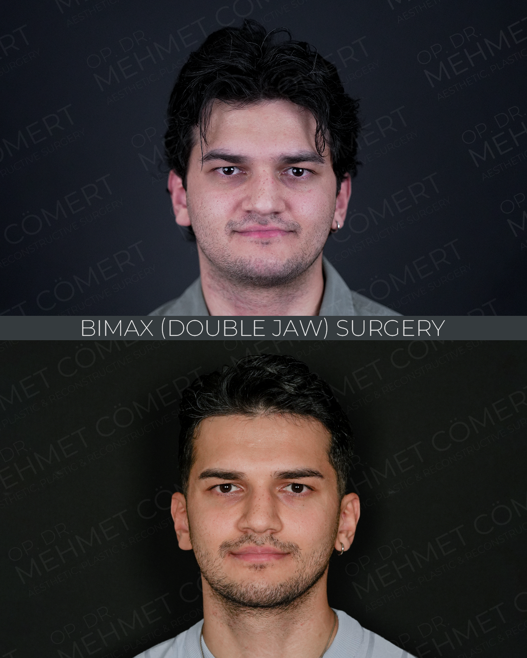 Bimax Surgery