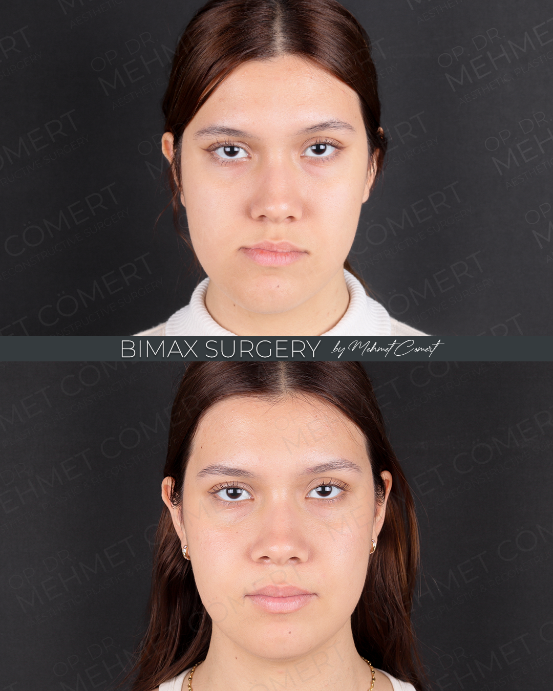 Bimax Surgery