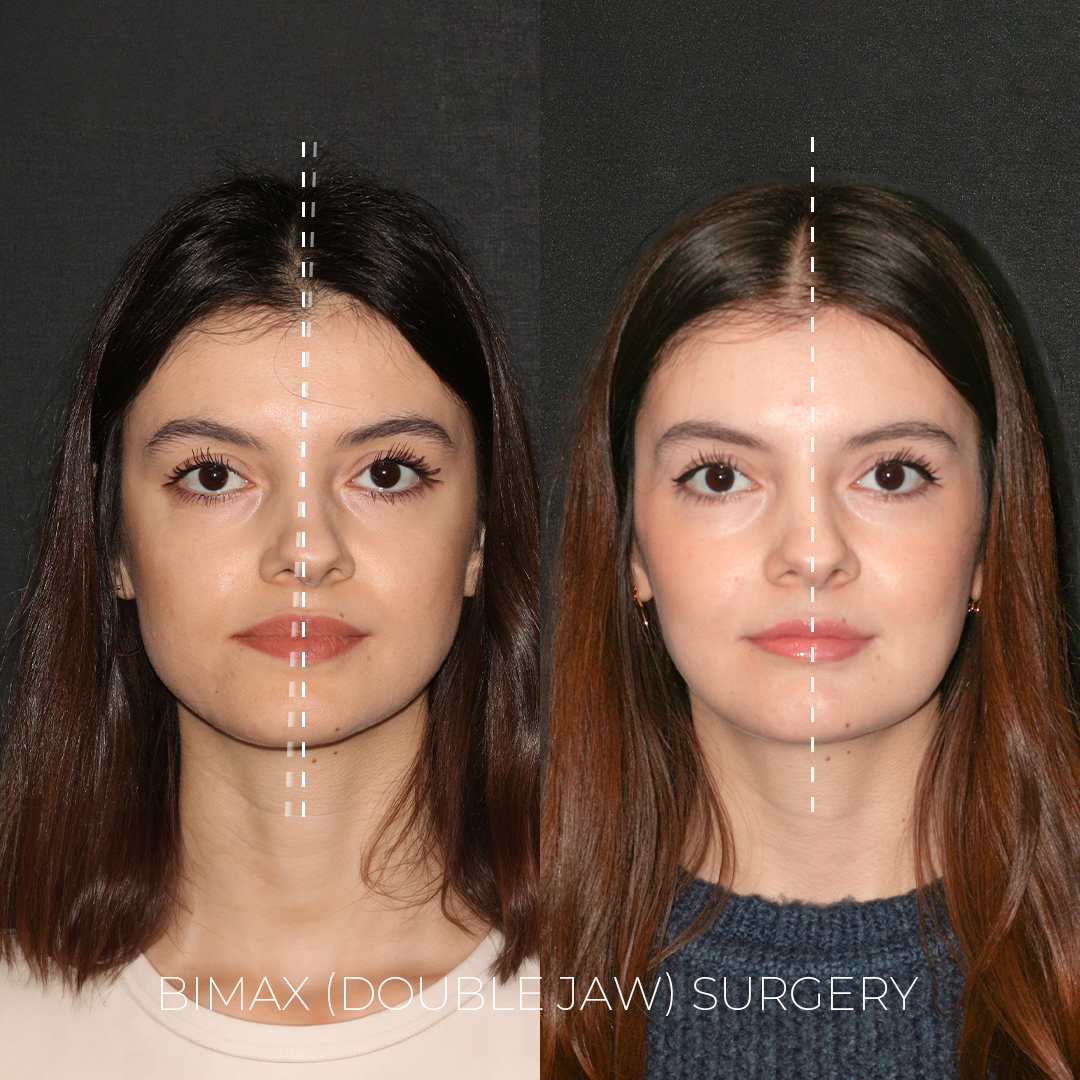 Facial Implants