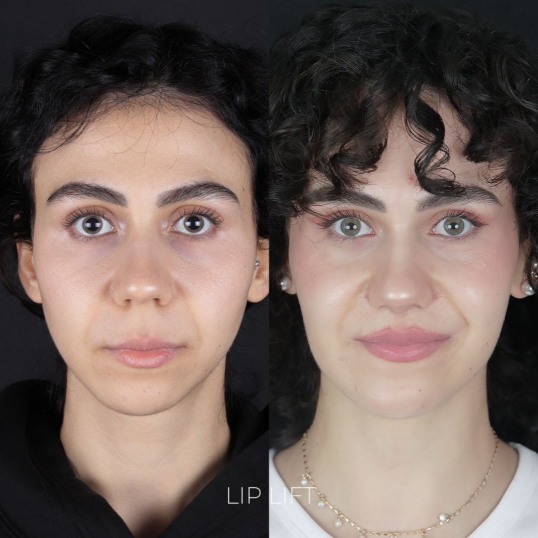 Lip Lift
