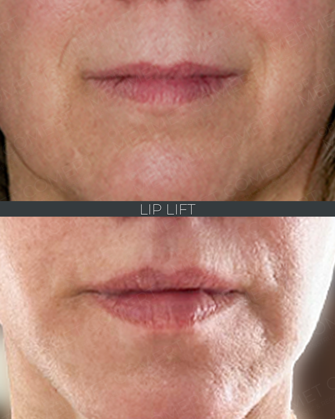 Lip Lift
