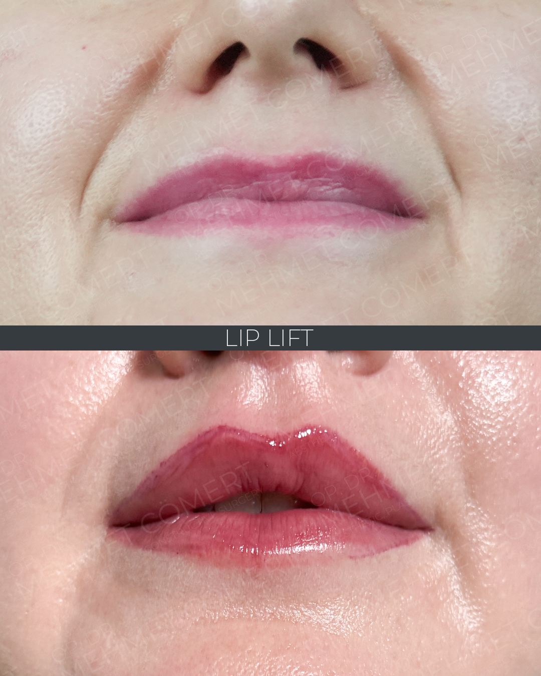 Lip Lift