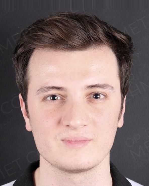 After — double jaw surgery with genioplasty