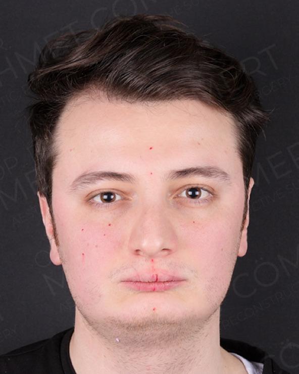 Before — double jaw surgery with genioplasty