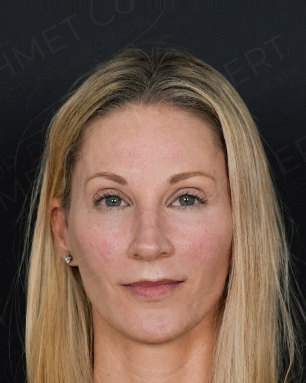 After — full facial rejuvenation