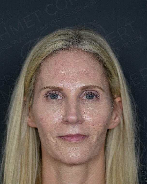 Before — full facial rejuvenation