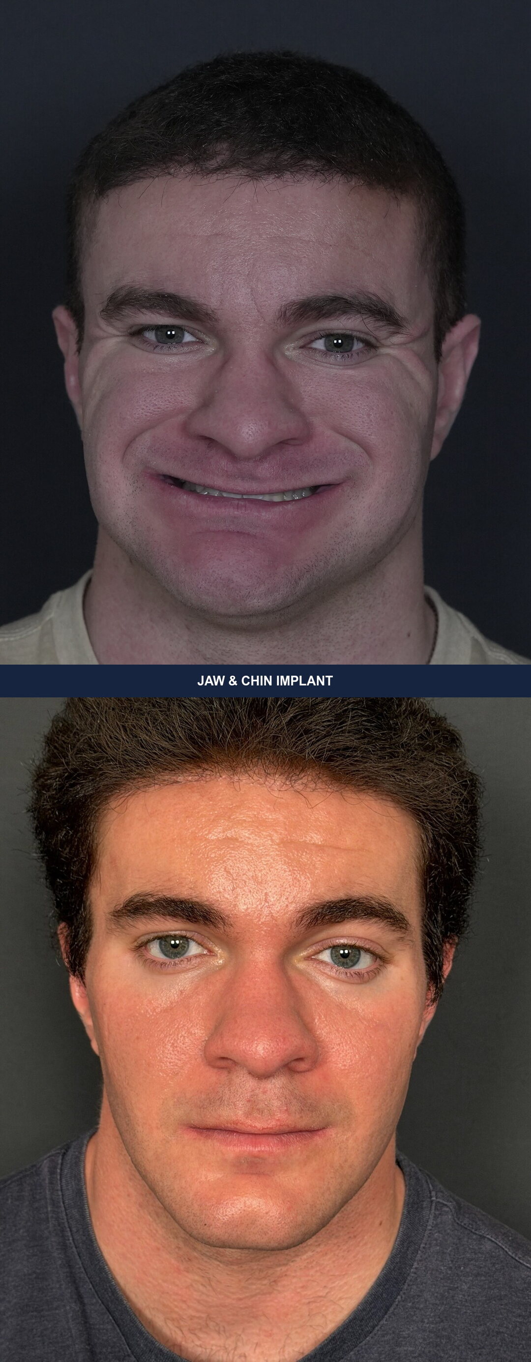 Front view before and after a custom jaw and chin implant masculinising the lower face