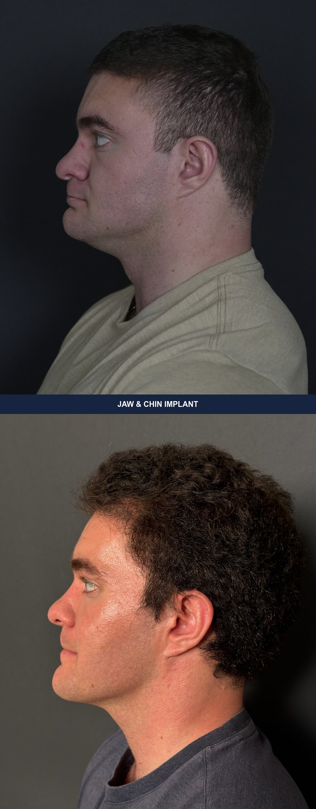 Profile before and after a custom jaw and chin implant showing increased gonial angle and chin projection