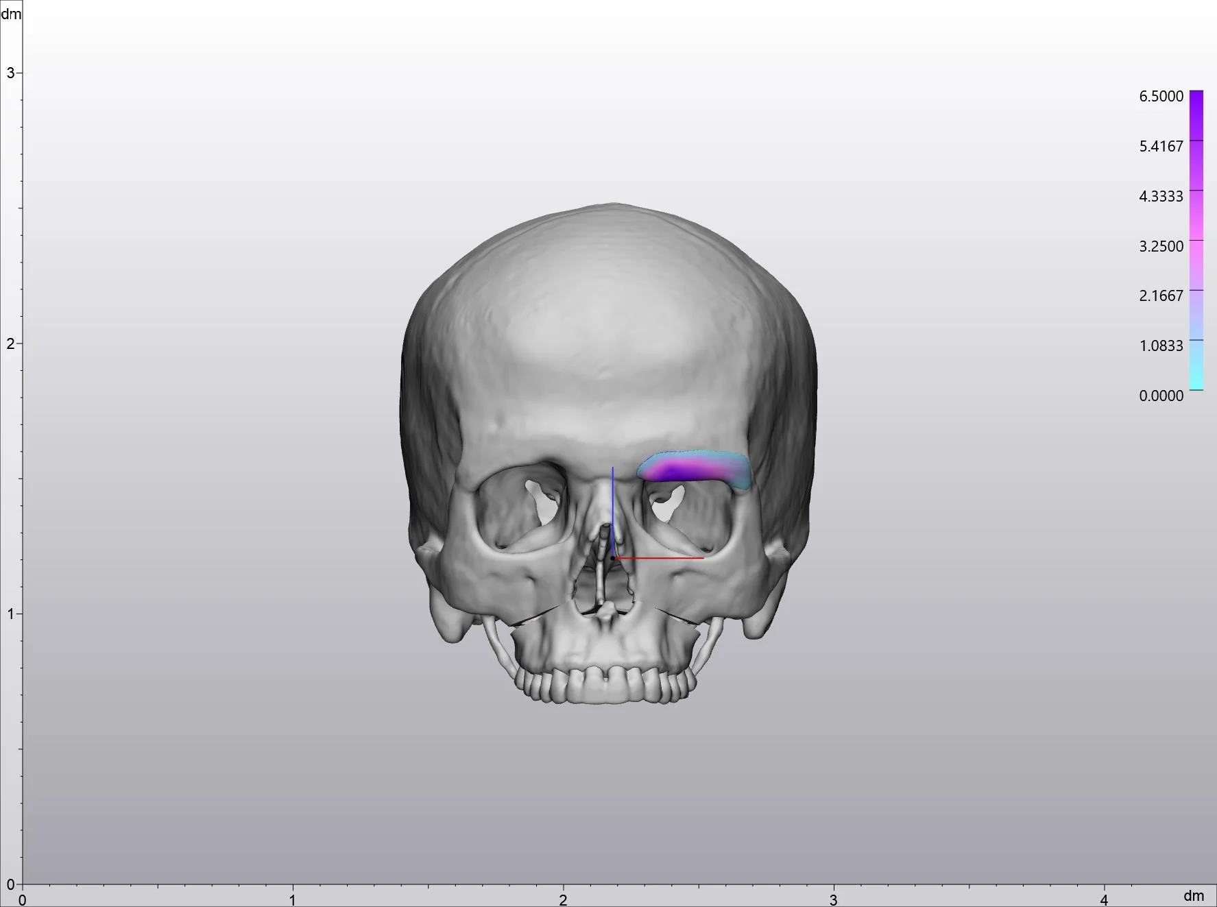 Virtual surgical plan of a single-sided custom supraorbital implant on a 3D skull model, with a colour thickness map peaking at 6.5 millimetres over the brow ridge.