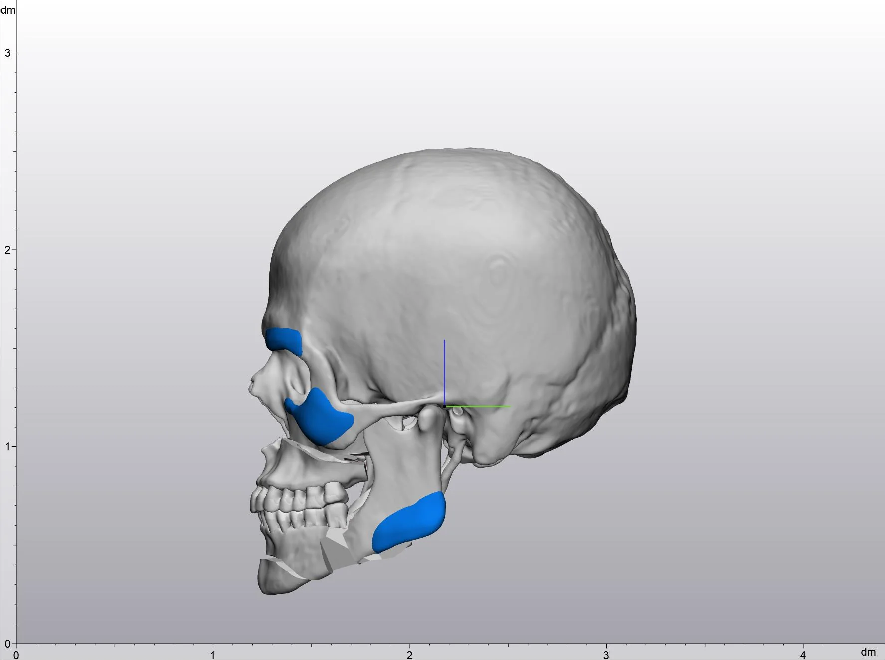 Oblique view of a virtual surgical plan showing custom supraorbital, infraorbital and jaw angle implants on a 3D skull model.