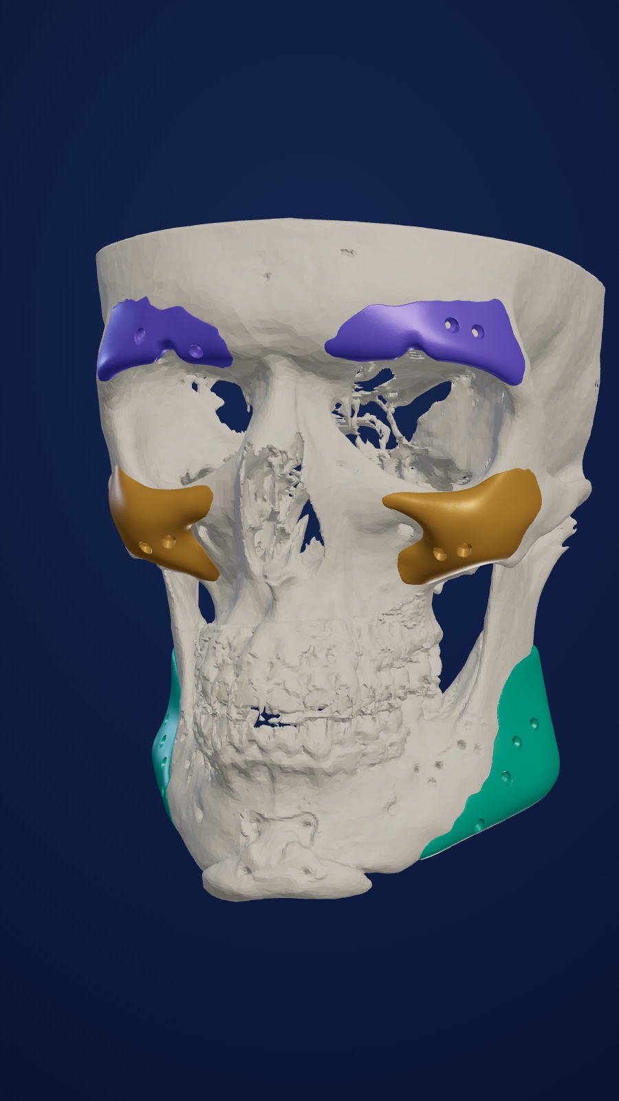 Patient-specific custom facial implants on a 3D skull model